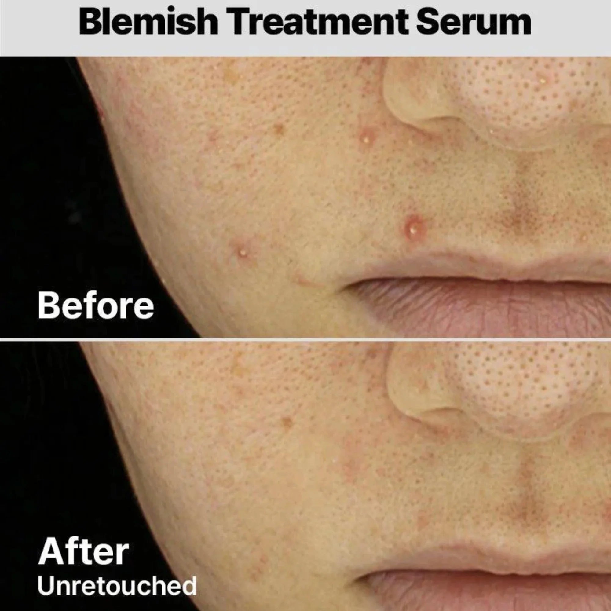 COSRX The AHA 2 BHA 2 Blemish Treatment Serum 50gm